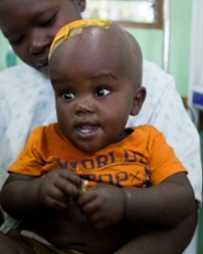 A young patient recovering from surgery for hydrocephalus in Uganda (source: Cure Children’s Hospital of Uganda)